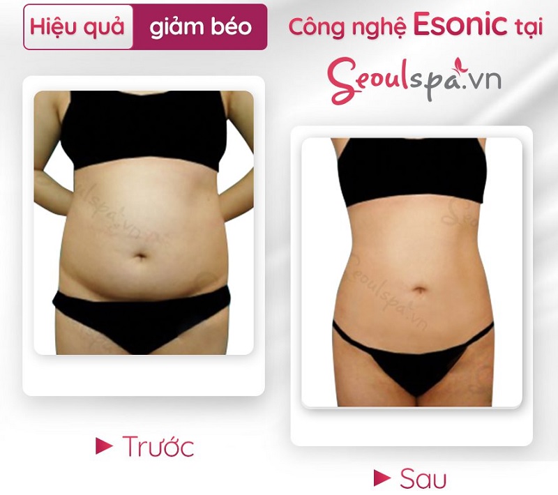 Dịch vụ giảm béo bụng tại Seoul Spa áp dụng cho cả nam lẫn nữ